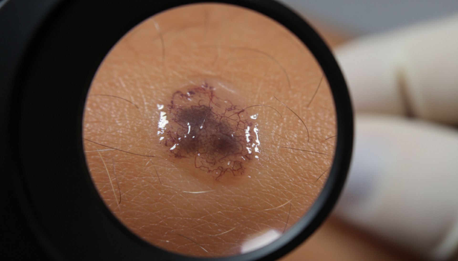 Dermoskopia: brutalna rzeczywistość diagnostyki skóry, której nie znasz