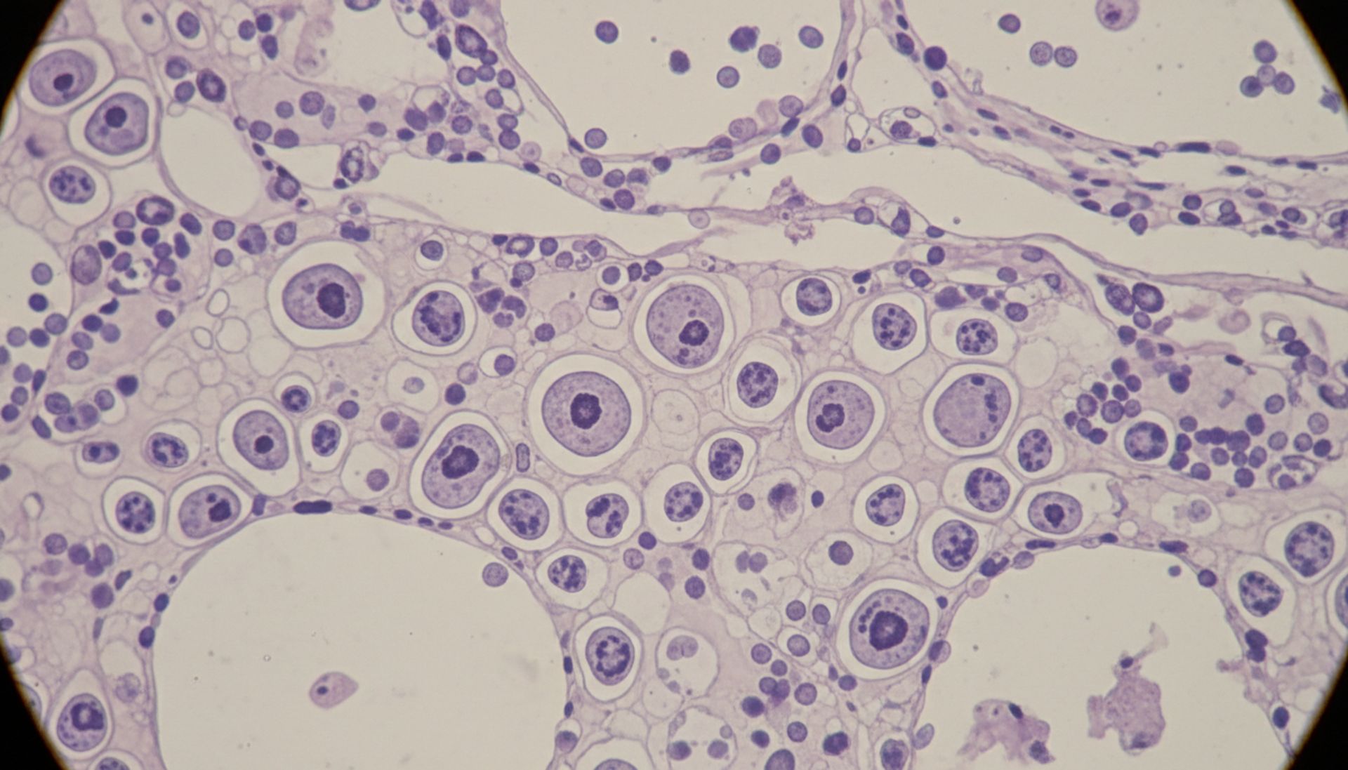 Dysplazja szyjki macicy: brutalna prawda, której nikt ci nie powie