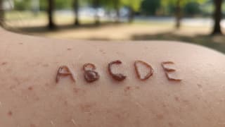 ABCDE znamion i AI – gdzie kończy się samokontrola skóry