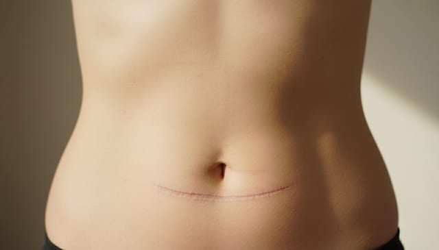 Abdominoplastyka: brutalna prawda, której nie usłyszysz w reklamach