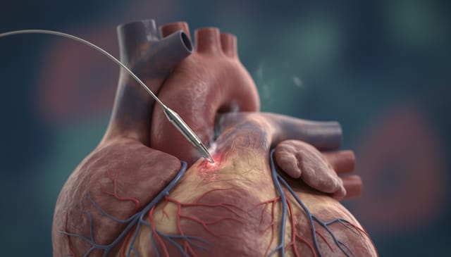 Ablacja RF: brutalnie szczera prawda o zabiegu, skutkach i przyszłości leczenia