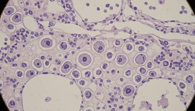 Dysplazja szyjki macicy: brutalna prawda, której nikt ci nie powie