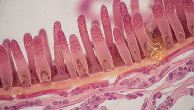 Uchyłki jelita: Brutalna rzeczywistość, którą przemilczają lekarze