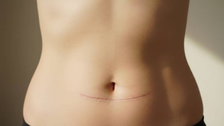 Abdominoplastyka w Polsce – decyzje poza ceną i mity