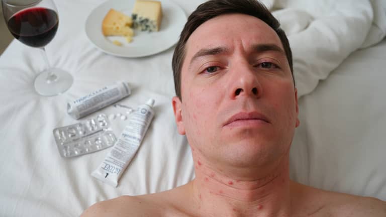 Histaminoza i mózg: gdy „alergia” udaje depresję i lęk