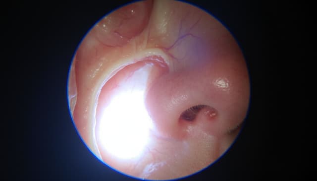Endoskopia nosa: jak przebiega i kiedy warto ją wykonać