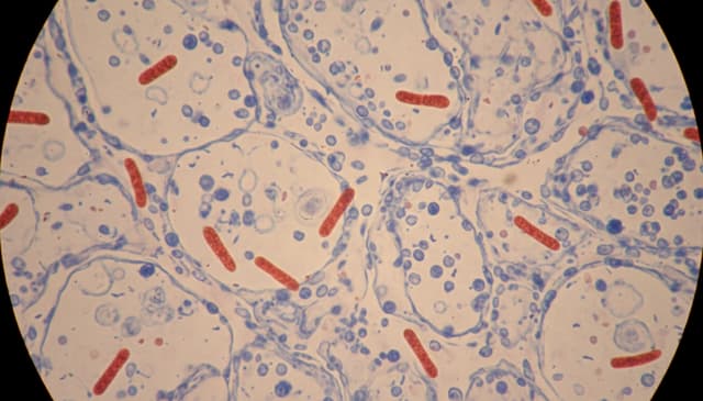 Gruźlica: kompleksowy przewodnik po diagnozie i leczeniu