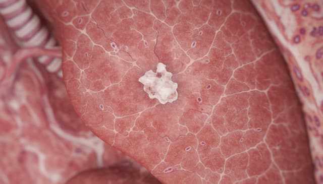 Guz płuc: kompleksowy przewodnik po diagnostyce i leczeniu