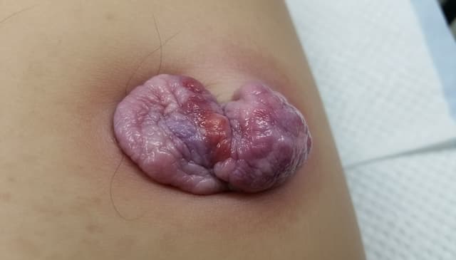 Hemoroidy: kompleksowy przewodnik po przyczynach i leczeniu