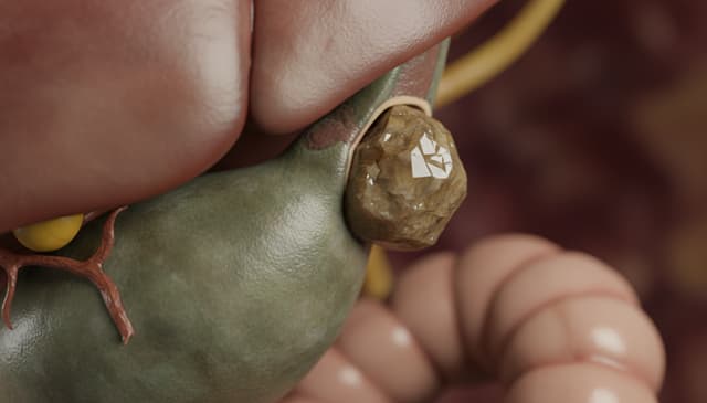 Kamica żółciowa: przyczyny, objawy i metody leczenia