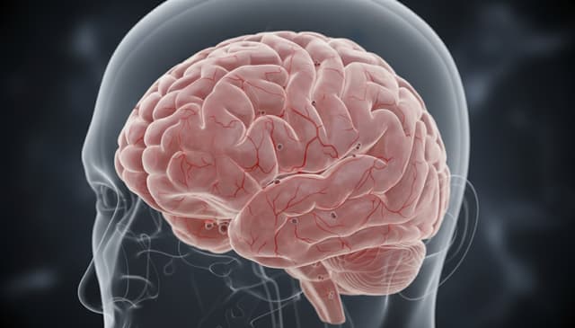 Krwotok podpajęczynówkowy: przyczyny, objawy i leczenie