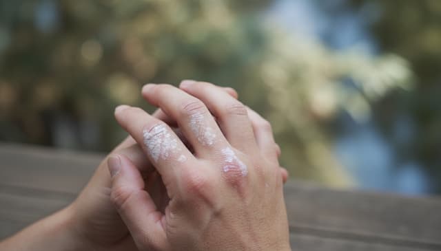 Łuszczycowe zapalenie stawów: kompleksowy przewodnik dla pacjentów