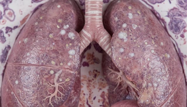 Mukowiscydoza: kompleksowy przewodnik po chorobie i leczeniu