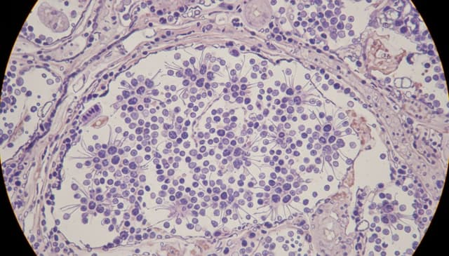 Neuroblastoma: kompleksowy przewodnik po objawach i leczeniu