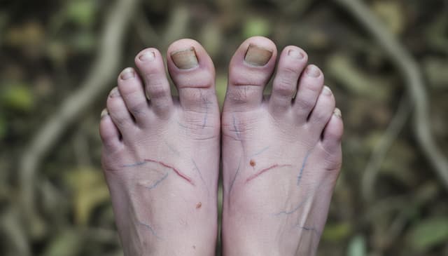 Neuropatia: kompleksowy przewodnik po przyczynach i leczeniu