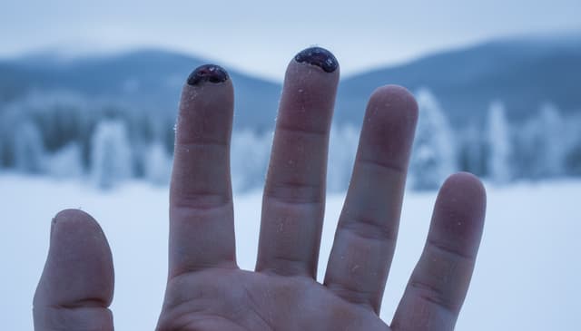 Odmrożenia: przyczyny, objawy i skuteczne metody leczenia