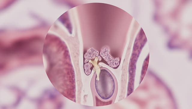 Otoskleroza: przyczyny, objawy i nowoczesne metody leczenia