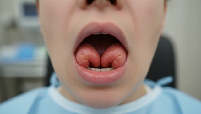 Powiększenie migdałków: przyczyny, objawy i metody leczenia