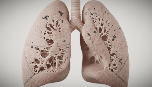 Rozedma płuc: przyczyny, objawy i nowoczesne metody leczenia