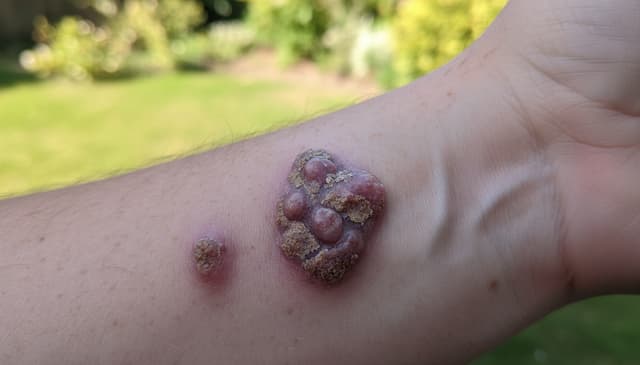 Rumień guzowaty: przyczyny, objawy i metody leczenia