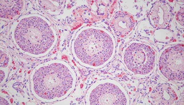 Sarkoidoza: kompleksowy przewodnik po chorobie i leczeniu