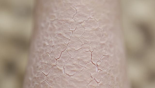 Suchość pochwy: przyczyny, objawy i skuteczne metody leczenia