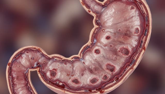 Wrzody żołądka: przyczyny, objawy i skuteczne metody leczenia