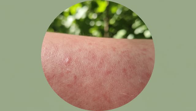 Zaczerwienienie skóry: przyczyny, objawy i skuteczne metody leczenia