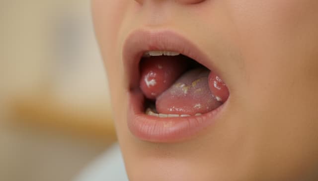 Zapalenie migdałków: przyczyny, objawy i skuteczne leczenie