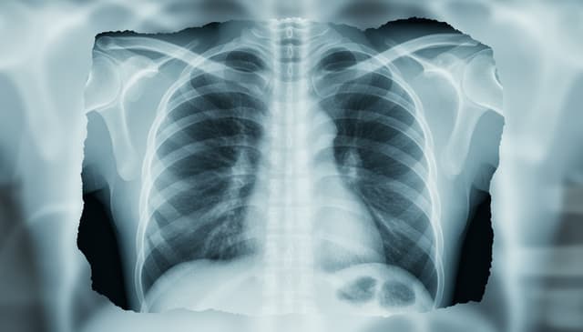 Zapalenie płuc: kompleksowy przewodnik po przyczynach i leczeniu