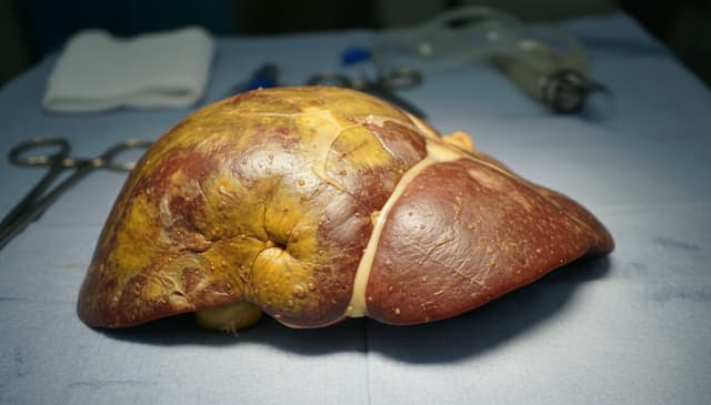 Zapalenie wątroby: przyczyny, objawy i metody leczenia