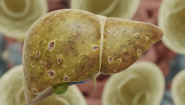 Zapalenie wątroby typu A: kompleksowy przewodnik dla pacjentów